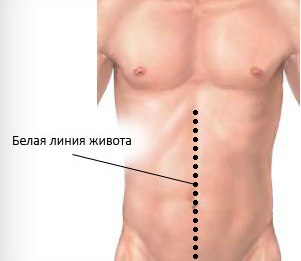 Немного о защемлении грыжи белой линии живота