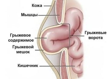 Почему возникает и как проявляется ущемлённая грыжа?