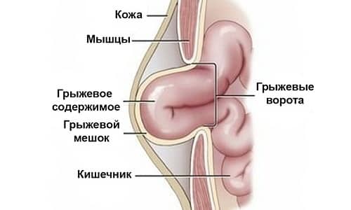 Ущемленная грыжа характеризуется сдавливанием грыжевого мешка и находящихся в нем внутренних органов между грыжевыми воротами