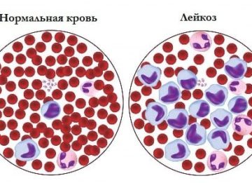 Характерные особенности развития хронического лимфоцитарного лейкоза