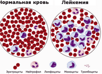 Симптомы и лечение хронического лейкоза
