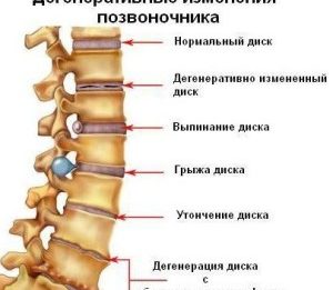 Какой бывает остеохондроз? Особенности и степени заболевания