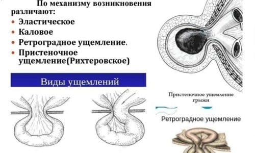 Ретроградное ущемление - это наиболее редкий вид патологии