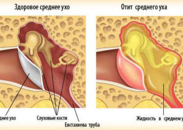 Характерные признаки и симптомы отита у грудничка