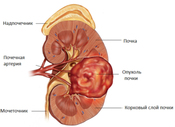 Жизнь с раком почки: условия и статистика выживаемости